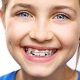 Keep Your Smile Straight with Retainers